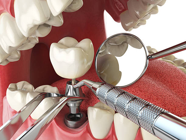 Best Knocked-Out Tooth Emergency  in Morrisonvle, IL